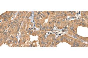 Immunohistochemistry of paraffin-embedded Human thyroid cancer tissue using BOLA1 Polyclonal Antibody at dilution of 1:35(x200) (BOLA1 anticorps)