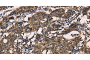 Immunohistochemistry of paraffin-embedded Human gastic cancer using SENP1 Polyclonal Antibody at dilution of 1:40 (SENP1 anticorps)
