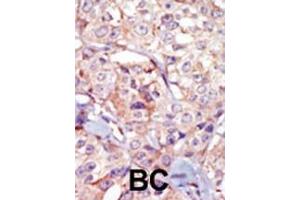 Formalin-fixed and paraffin-embedded human cancer tissue reacted with the primary antibody, which was peroxidase-conjugated to the secondary antibody, followed by AEC staining.
