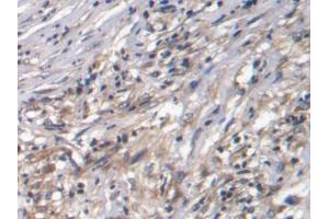 IHC-P analysis of Human Ovarian cancer Tissue, with DAB staining. (CTGF anticorps  (AA 80-200))