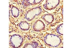 Immunohistochemistry of paraffin-embedded human gastric cancer using ABIN7157538 at dilution of 1:100