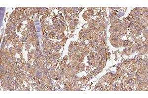 ABIN6278586 at 1/100 staining Human Melanoma tissue by IHC-P. (KLHL3 anticorps  (N-Term))
