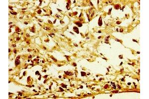 IHC image of ABIN7153729 diluted at 1:300 and staining in paraffin-embedded human melanoma performed on a Leica BondTM system. (POFUT2 anticorps  (AA 125-271))