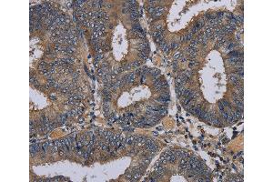Immunohistochemistry of Human esophagus cancer using PVRL3 Polyclonal Antibody at dilution of 1:40 (nectin-3 anticorps)