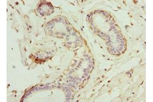 Immunohistochemistry of paraffin-embedded human breast cancer using ABIN7160702 at dilution of 1:100