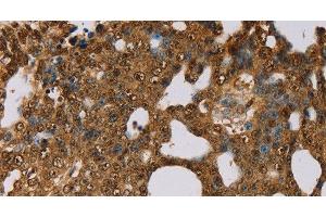 Immunohistochemistry of paraffin-embedded Human cervical cancer using PSMC2 Polyclonal Antibody at dilution of 1:30