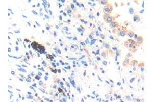 Detection of CTSK in Human Lung cancer Tissue using Polyclonal Antibody to Cathepsin K (CTSK)