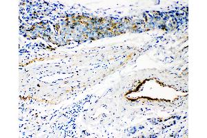Anti-HYAL3 antibody, IHC(P) IHC(P): Human Mammary Cancer Tissue (HYAL3 anticorps  (C-Term))