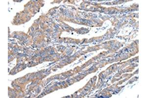 The image on the left is immunohistochemistry of paraffin-embedded Human esophagus cancer tissue using ABIN7193094(ZFAND2A Antibody) at dilution 1/30, on the right is treated with synthetic peptide. (ZFAND2A anticorps)