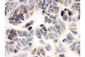 ICC testing of FFPE human MCF7 cells with PRDX3 antibody. (Peroxiredoxin 3 anticorps  (AA 110-256))