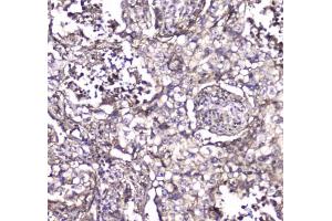 IHC testing of FFPE human rectal cancer tissue with S100A10 antibody at 1ug/ml.