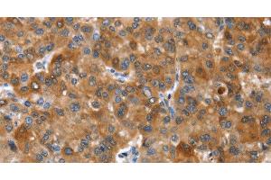 Immunohistochemistry of paraffin-embedded Human liver cancer tissue using NOD2 Polyclonal Antibody at dilution 1:40 (NOD2 anticorps)