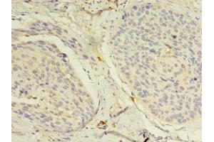 Immunohistochemistry of paraffin-embedded human cervical cancer using ABIN7160712 at dilution of 1:100 (NAT8 anticorps  (AA 64-227))