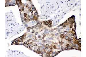 Anti- KIN Picoband antibody, IHC(P) IHC(P): Human Oesophagus Squama Cancer Tissue (KIN anticorps  (AA 3-202))