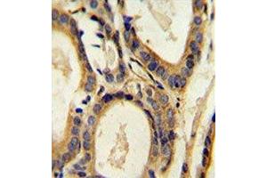 CCL4 antibody immunohistochemistry analysis in formalin fixed and paraffin embedded human prostate carcinoma. (CCL4 anticorps  (AA 22-48))