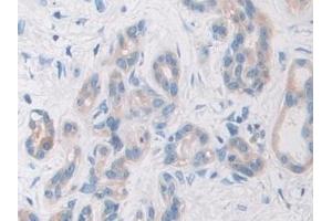 Detection of PYGB in Human Pancreatic cancer Tissue using Polyclonal Antibody to Glycogen Phosphorylase, Brain (PYGB)