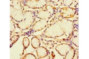 Immunohistochemistry of paraffin-embedded human gastric cancer using ABIN7147035 at dilution of 1:100 (CATSPER4 anticorps  (AA 306-472))
