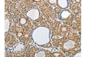 The image on the left is immunohistochemistry of paraffin-embedded Human thyroid cancer tissue using ABIN7189752(AKAP6 Antibody) at dilution 1/30, on the right is treated with synthetic peptide.