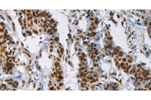 Immunohistochemistry of paraffin-embedded Human gastic cancer using IL17C Polyclonal Antibody at dilution of 1:50 (IL17C anticorps)