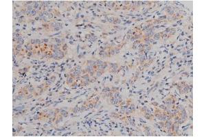ABIN6267496 at 1/200 staining Human ganstric cancer tissue sections by IHC-P. (SNCA anticorps  (pSer129))