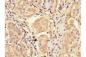Immunohistochemistry of paraffin-embedded human liver cancer using ABIN7148885 at dilution of 1:100