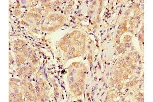Immunohistochemistry of paraffin-embedded human liver cancer using ABIN7148885 at dilution of 1:100 (CDKN2B anticorps  (AA 1-138))