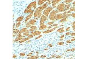 Immunohistochemical staining (Formalin-fixed paraffin-embedded sections) of human melanoma with S100 monoclonal antibody, clone 4C4. (S100A1 anticorps)