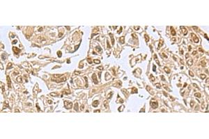Immunohistochemistry of paraffin-embedded Human lung cancer tissue using NVL Polyclonal Antibody at dilution of 1:80(x200) (NVL anticorps)