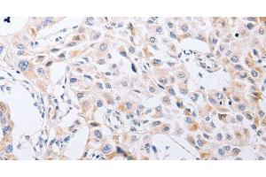 Immunohistochemistry of paraffin-embedded Human lung cancer tissue using SERP1 Polyclonal Antibody at dilution 1:30 (SERP1 anticorps)