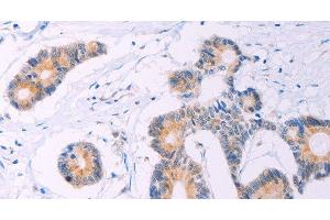 Immunohistochemistry of paraffin-embedded Human colon cancer tissue using ADCY5 Polyclonal Antibody at dilution 1:30