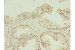 Immunohistochemistry of paraffin-embedded human prostate cancer using ABIN7173059 at dilution of 1:100 (TMEM141 anticorps  (AA 1-108))