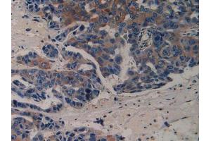 IHC-P analysis of Human Breast Cancer Tissue, with DAB staining. (VEGFR2/CD309 anticorps  (AA 46-320))