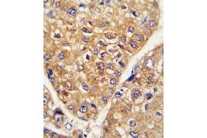 Formalin-fixed and paraffin-embedded human hepatocarcinoma reacted with GARP Antibody (Center), which was peroxidase-conjugated to the secondary antibody, followed by DAB staining.