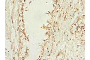 Immunohistochemistry of paraffin-embedded human breast cancer using ABIN7163649 at dilution of 1:100 (PLEKHF2 anticorps  (AA 1-249))