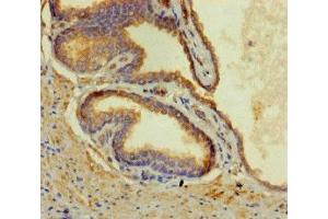 Immunohistochemistry of paraffin-embedded human prostate cancer using ABIN7148597 at dilution of 1:100 (CORO1B anticorps  (AA 252-453))