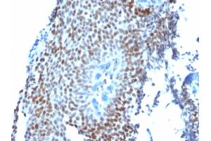 Formalin-fixed, paraffin-embedded human Bladder Carcinoma stained with p21 Mouse Monoclonal Antibody (CIP1/823). (p21 anticorps)