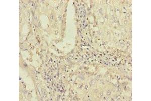 Immunohistochemistry of paraffin-embedded human lung cancer using ABIN7163315 at dilution of 1:100 (PLAA anticorps  (AA 536-795))