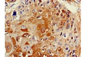 Immunohistochemistry of paraffin-embedded human cervical cancer using ABIN7171915 at dilution of 1:100 (TTC19 anticorps  (AA 108-380))