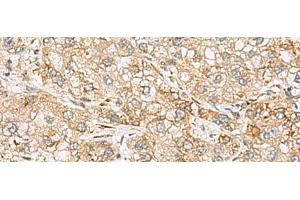 Immunohistochemistry of paraffin-embedded Human liver cancer tissue using SH3GL2 Polyclonal Antibody at dilution of 1:80(x200)