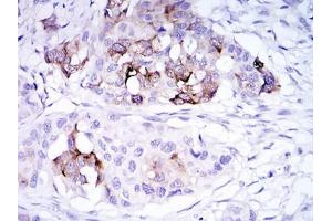 Immunohistochemical analysis of paraffin-embedded mammary cancer tissues using SCGB2A2 antibody with DAB staining. (Mammaglobin A anticorps)
