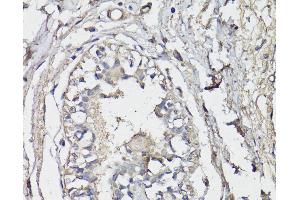 Immunohistochemistry of paraffin-embedded Human breast using BAP1 Polyclonal Antibody at dilution of 1:150 (40x lens).