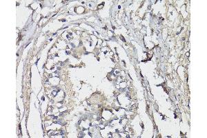 Immunohistochemistry of paraffin-embedded Human breast using BAP1 Polyclonal Antibody at dilution of 1:150 (40x lens). (BAP1 anticorps)