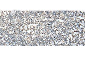 Immunohistochemistry of paraffin-embedded Human tonsil tissue using VASP Polyclonal Antibody at dilution of 1:30(x200) (VASP anticorps)