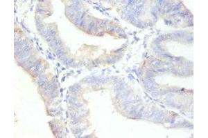 Immunohistochemistry of paraffin-embedded human endometrial cancer using ABIN7164742 at dilution of 1:100