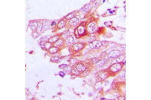 Immunohistochemical analysis of MUC13 staining in human lung cancer formalin fixed paraffin embedded tissue section.
