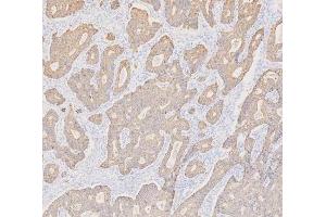 IHC analysis of Cytokeratin 19 using anti-Cytokeratin 19 antibody (ABIN3043288).