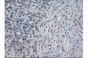 Immunohistochemical staining of paraffin-embedded Adenocarcinoma of ovary tissue using anti-SLC2A5mouse monoclonal antibody. (SLC2A5 anticorps)