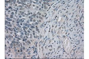 Immunohistochemical staining of paraffin-embedded Adenocarcinoma of ovary tissue using anti-SLC2A5mouse monoclonal antibody.