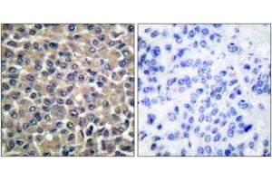 Immunohistochemistry analysis of paraffin-embedded human breast carcinoma tissue, using MMP-19 Antibody. (MMP19 anticorps  (AA 11-60))