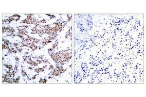Immunohistochemical analysis of paraffin-embedded human breast carcinoma tissue using MEF2A(Phospho-Thr312) Antibody(left) or the same antibody preincubated with blocking peptide(right). (MEF2A anticorps  (pThr312))